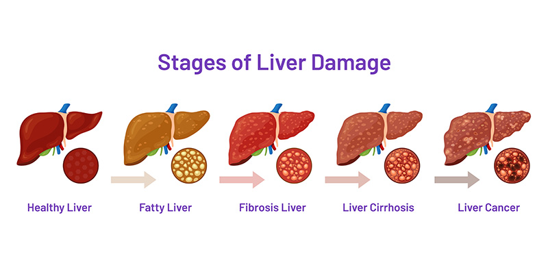 Liver Tumor Surgery: A Complete Guide