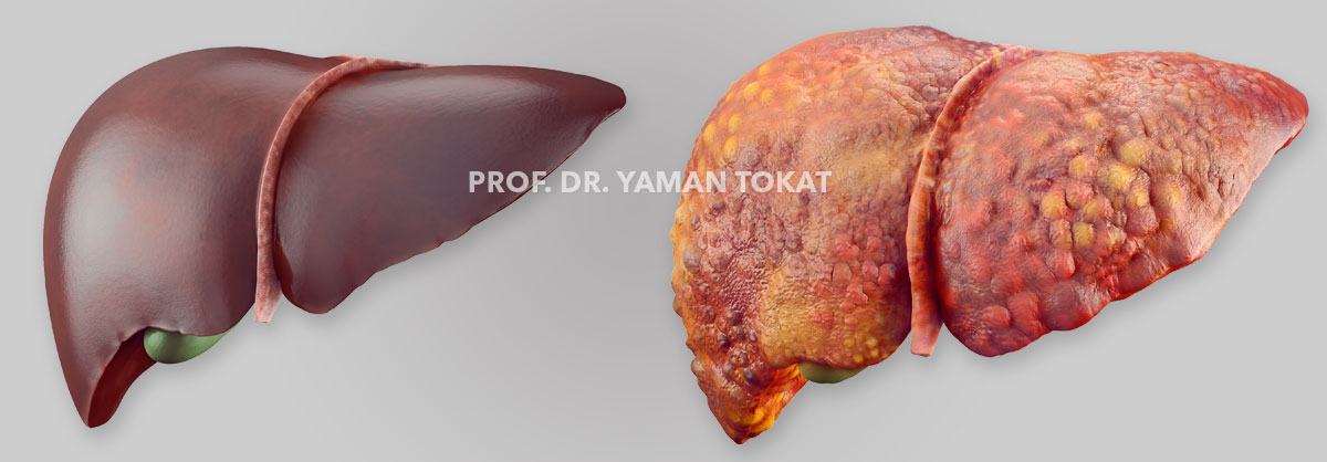 Sağlıklı ve Hasta Karaciğer Sağlıklı ve Hasta Karaciğer