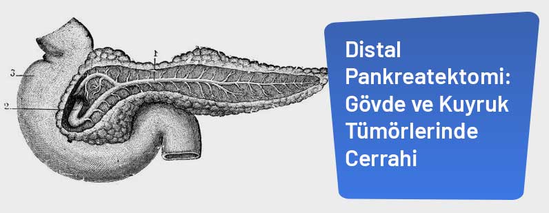 Distal Pankreatektomi: Gövde ve Kuyruk Tümörlerinde Cerrahi